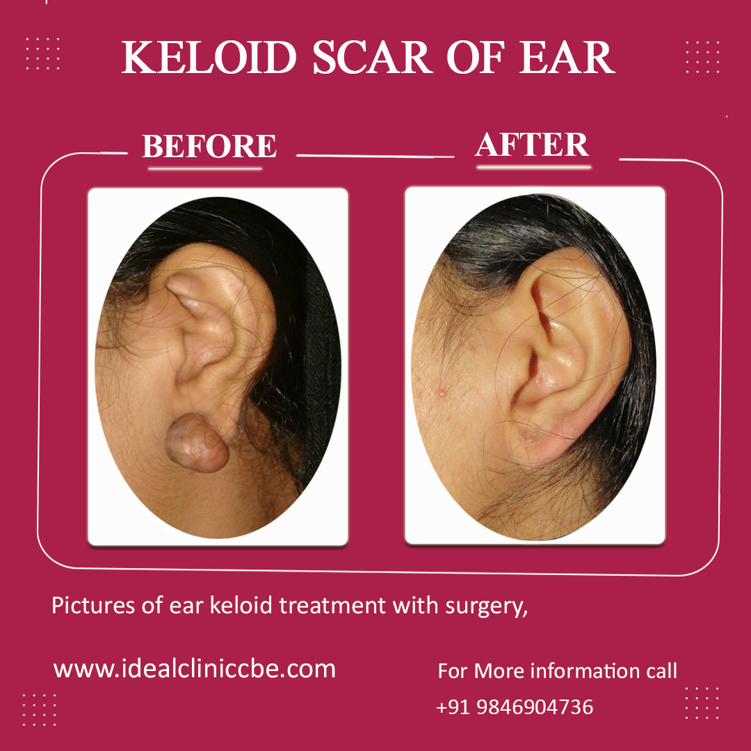 Keloid Scar Of Ear Ideal Clinic